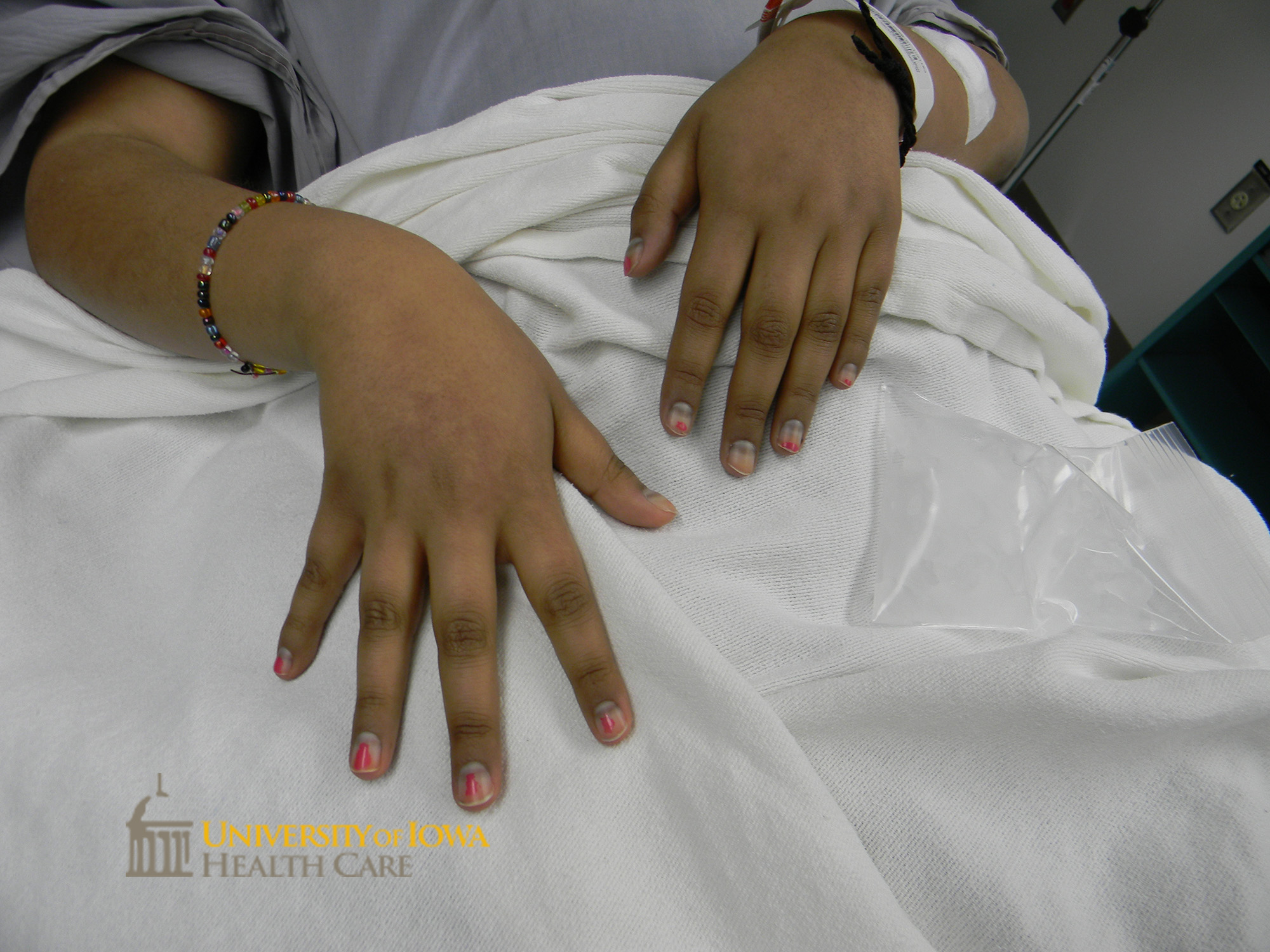 A transverse brown band on the proximal fingernails. (click images for higher resolution).